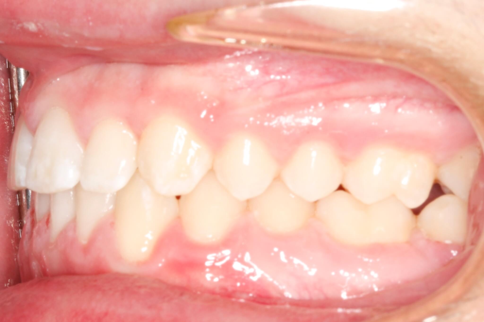 bite-correction-after