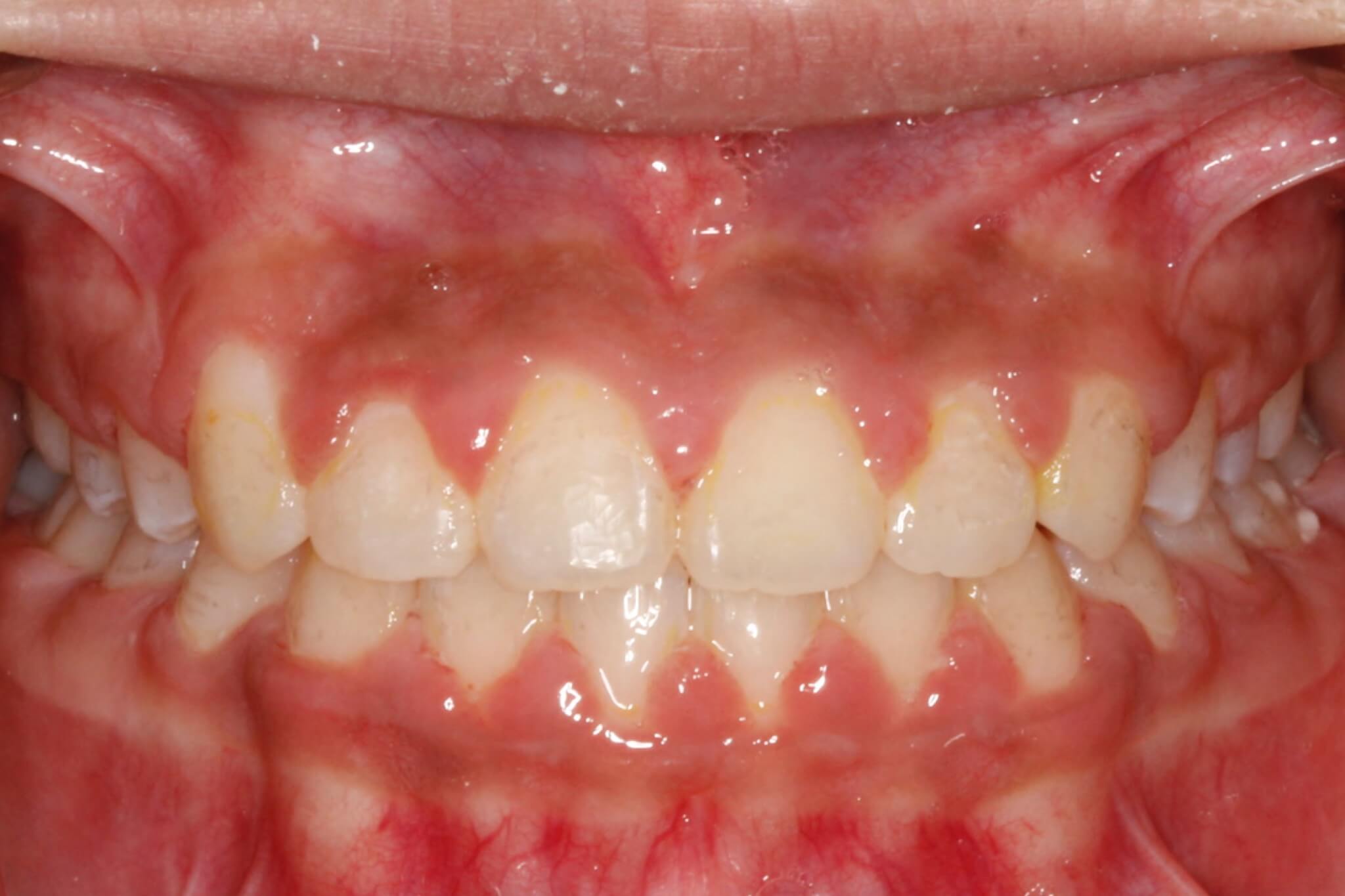 bite-correction-after3