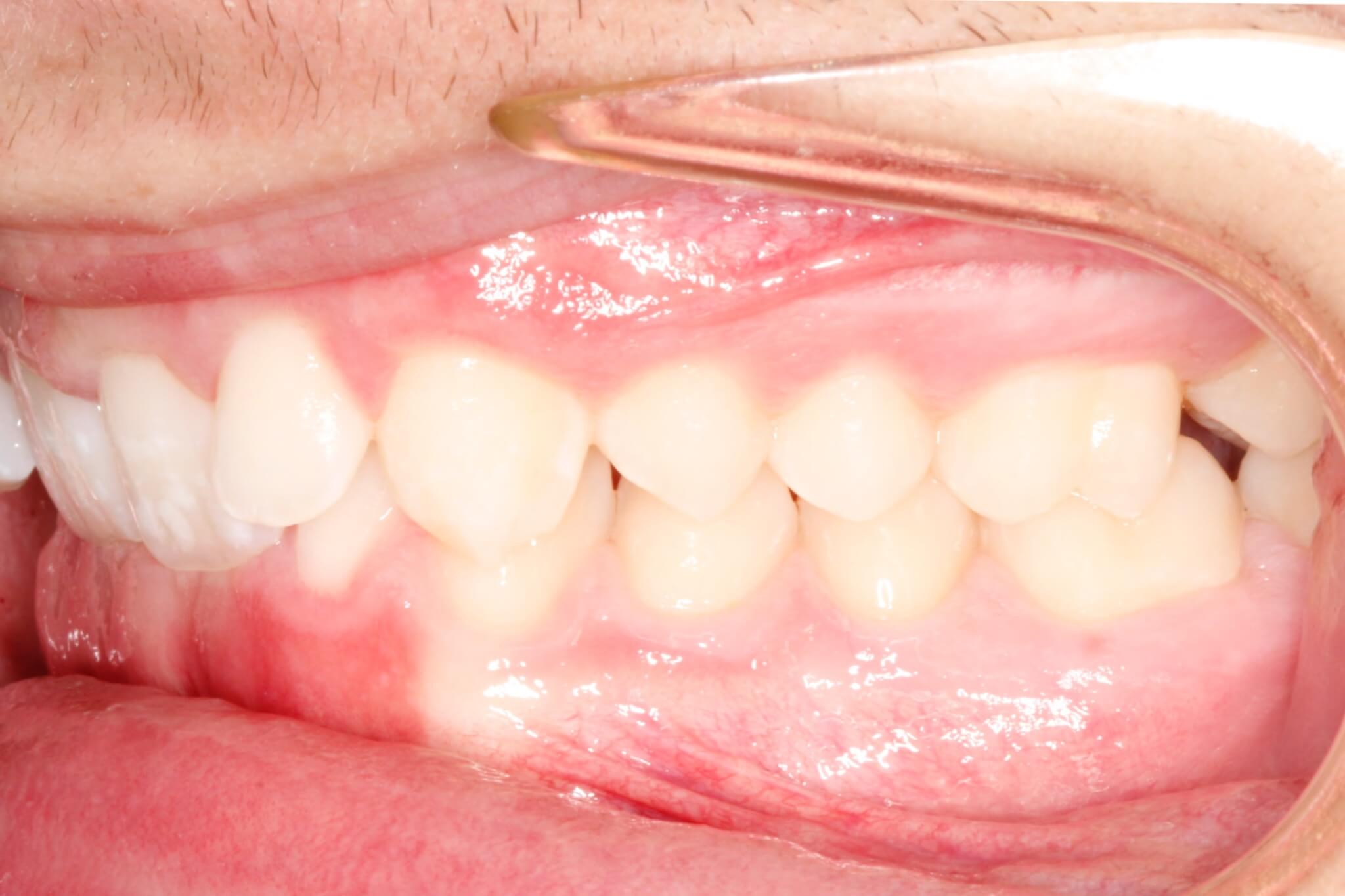 bite-correction-before bite-correction-before