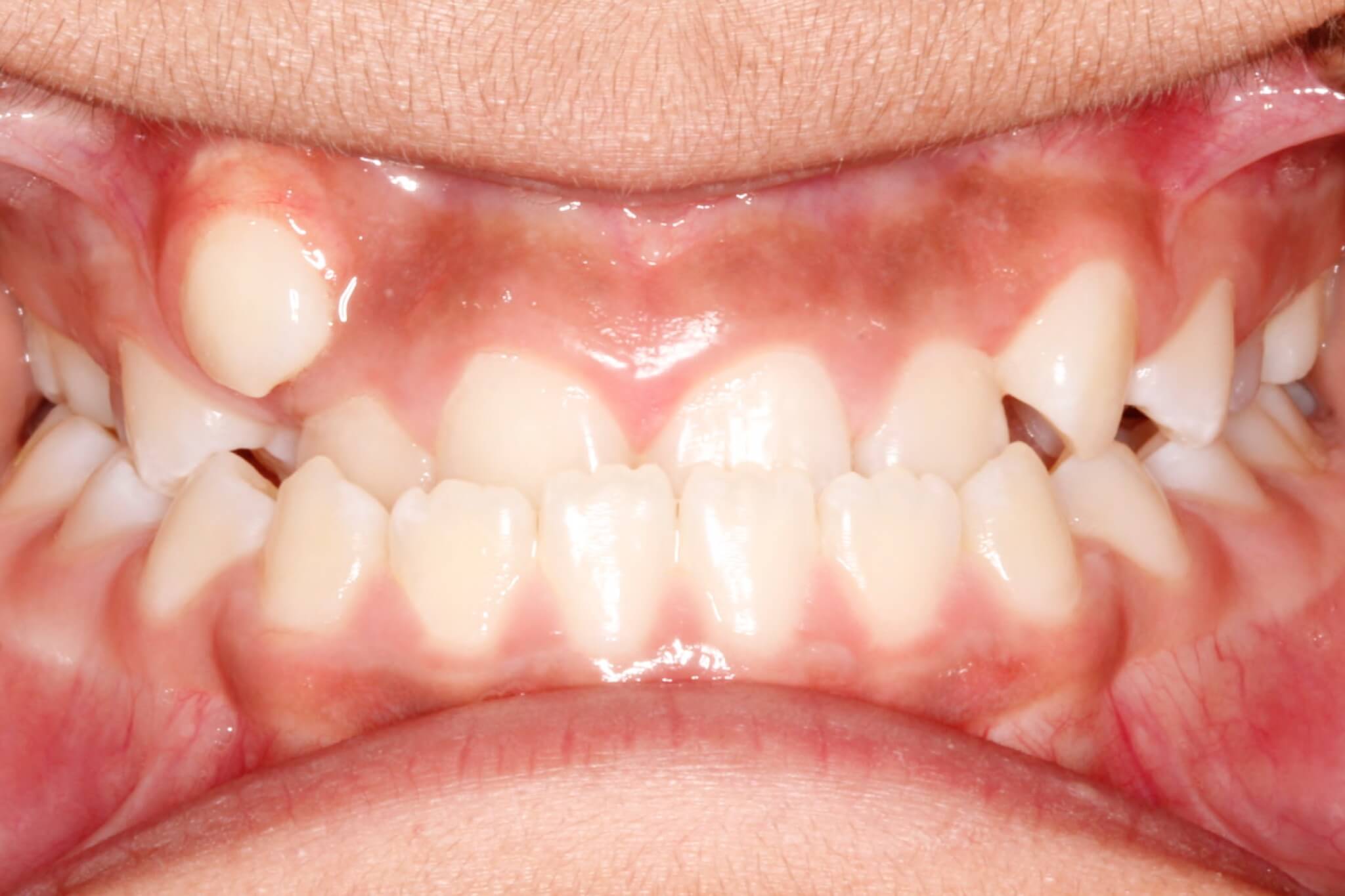 bite-correction-before3 bite-correction-before3