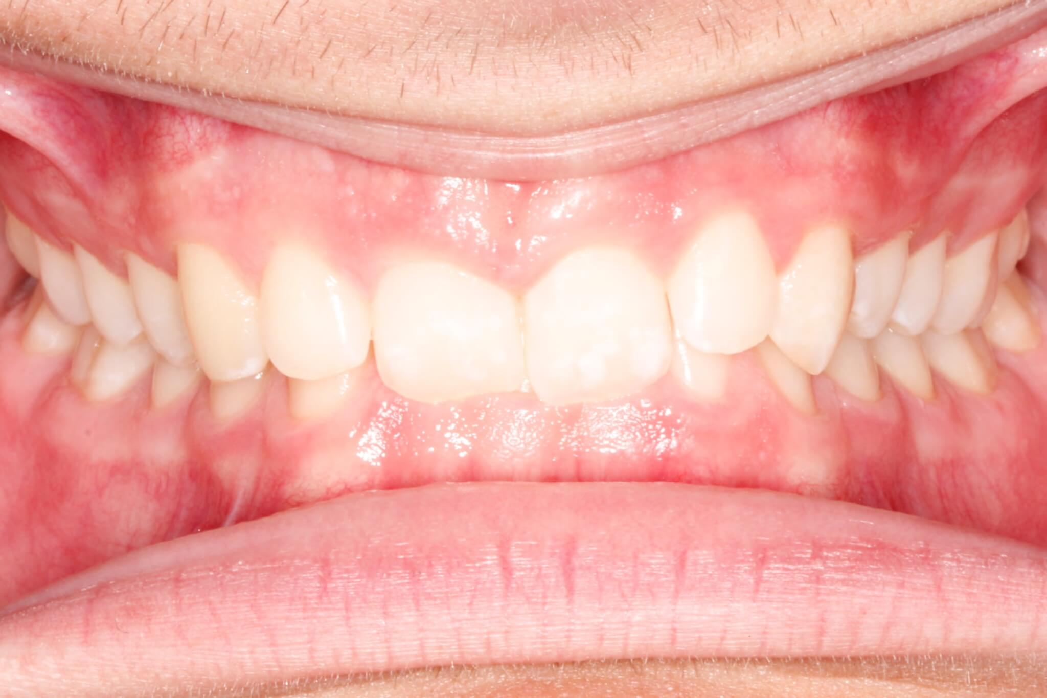 deepbite-before deepbite-before