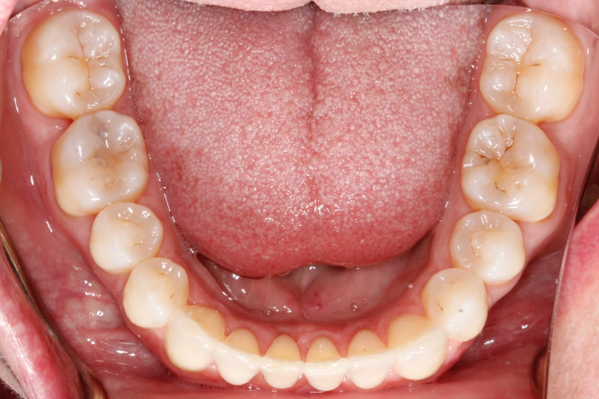 dental-crowding-after