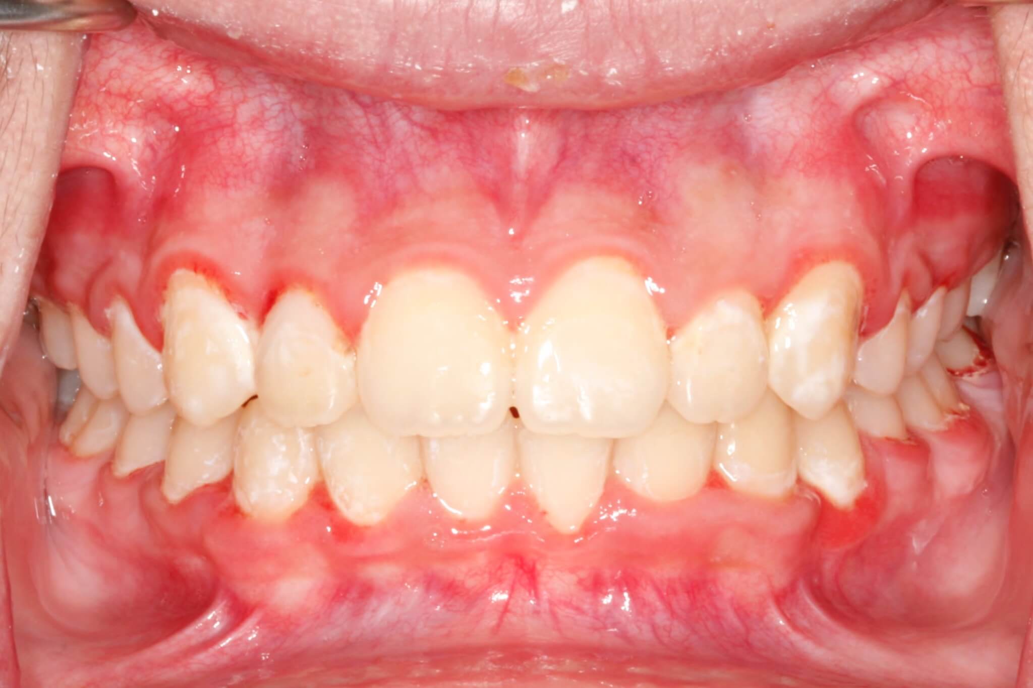 dental-crowding-after2