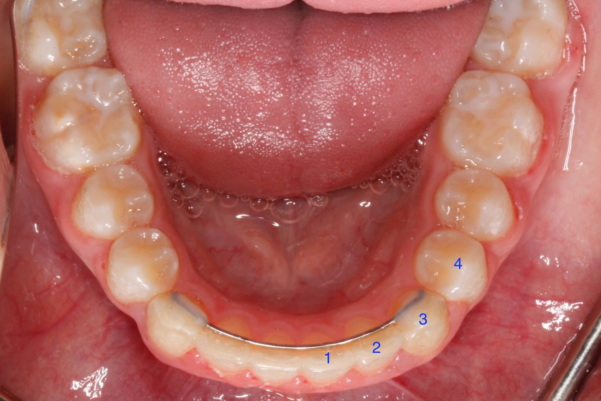 dental-crowding-after3