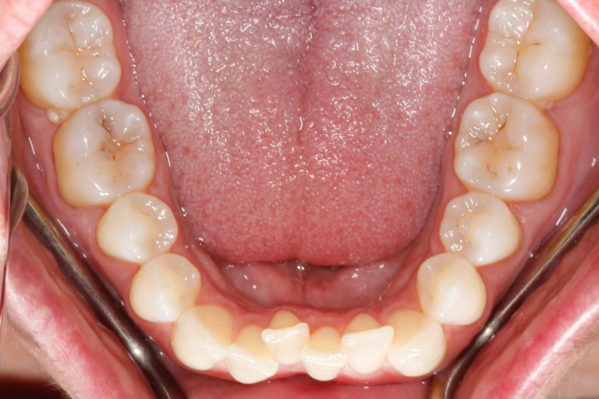 dental-crowding-before dental-crowding-before