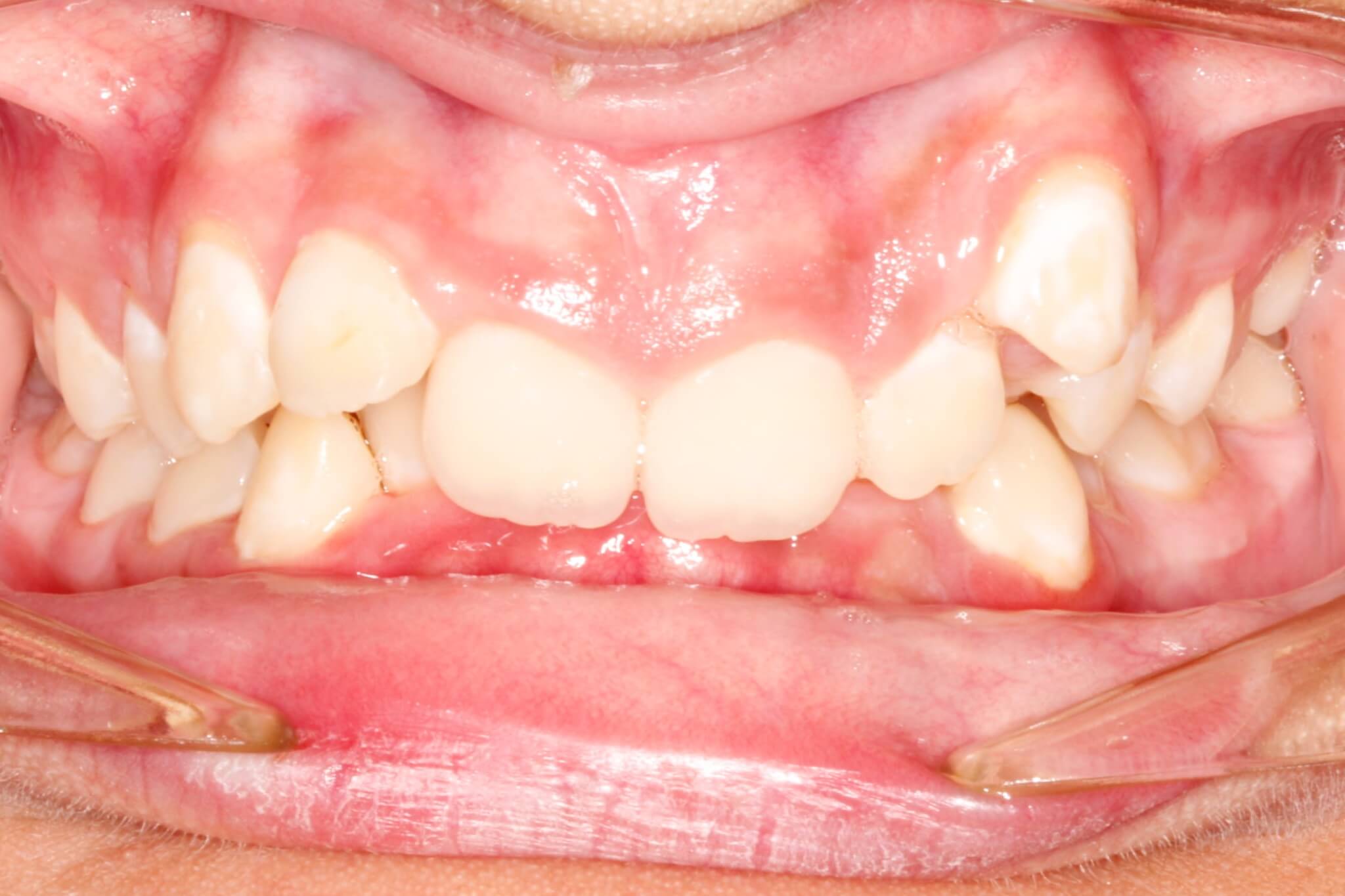 dental-crowding-before2 dental-crowding-before2