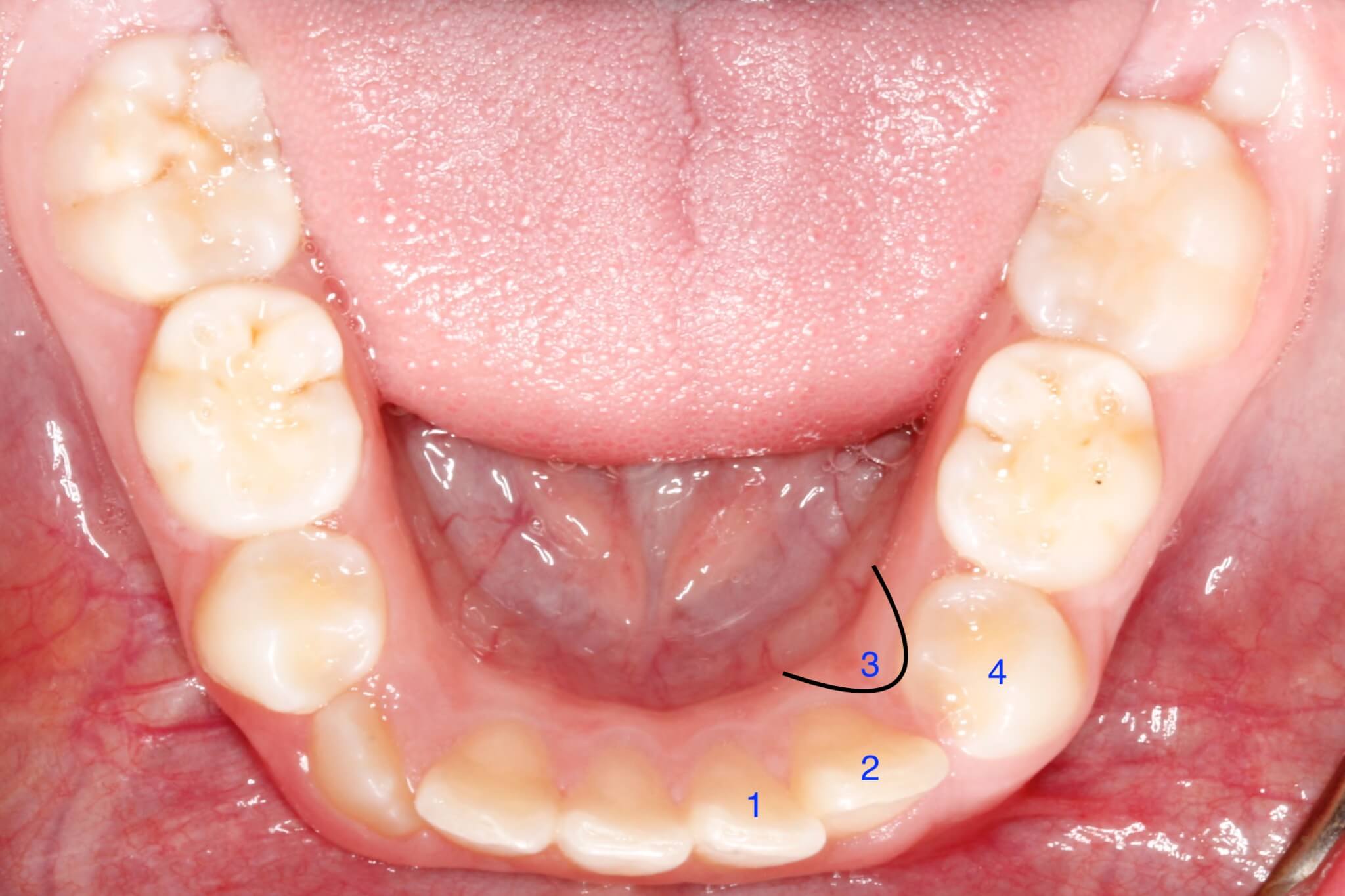 dental-crowding-before3 dental-crowding-before3