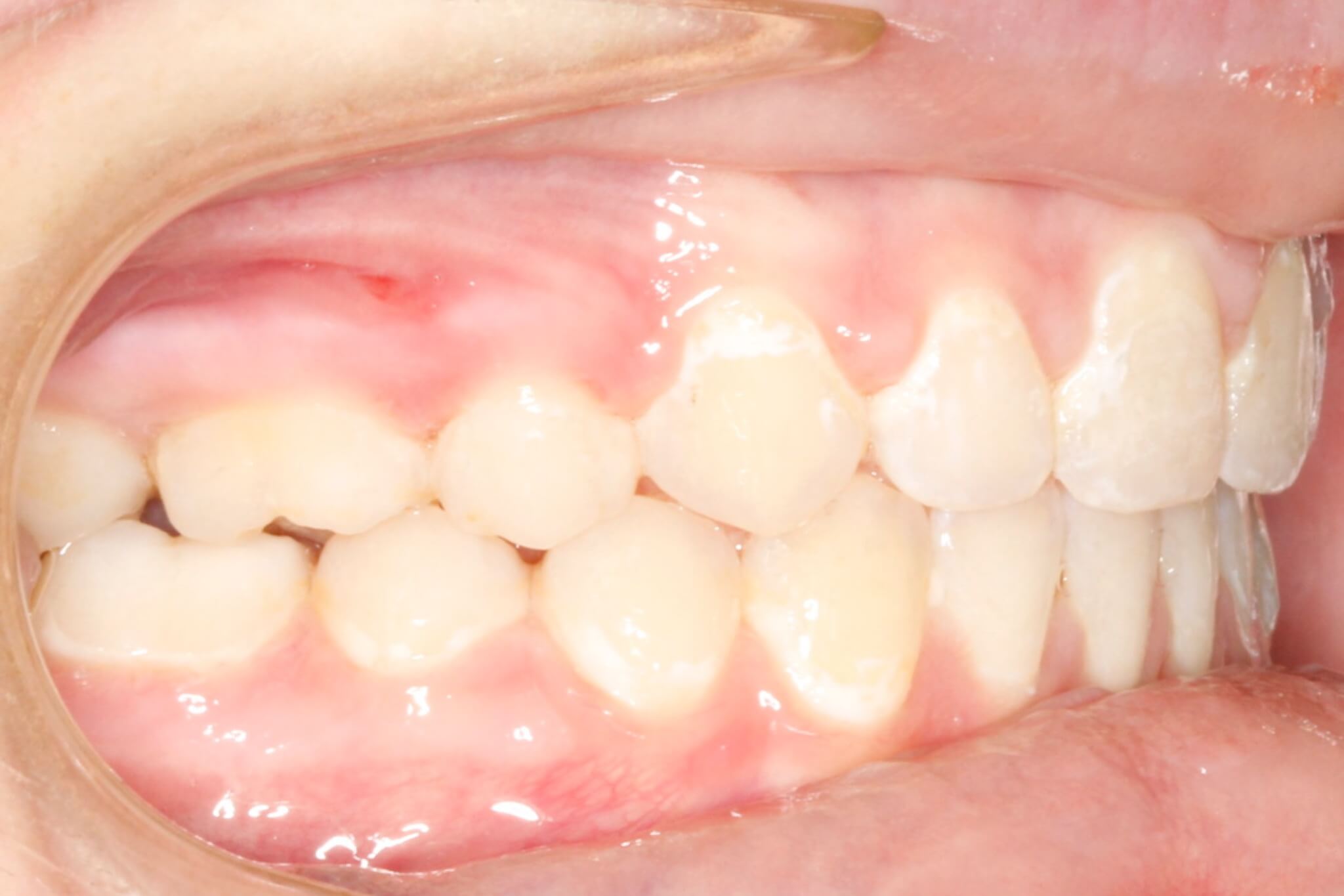 excess-overjet-after