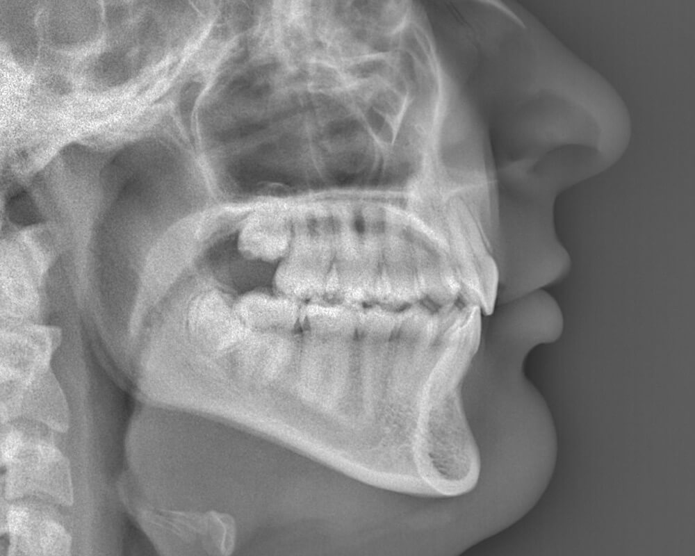 excess-overjet-after2