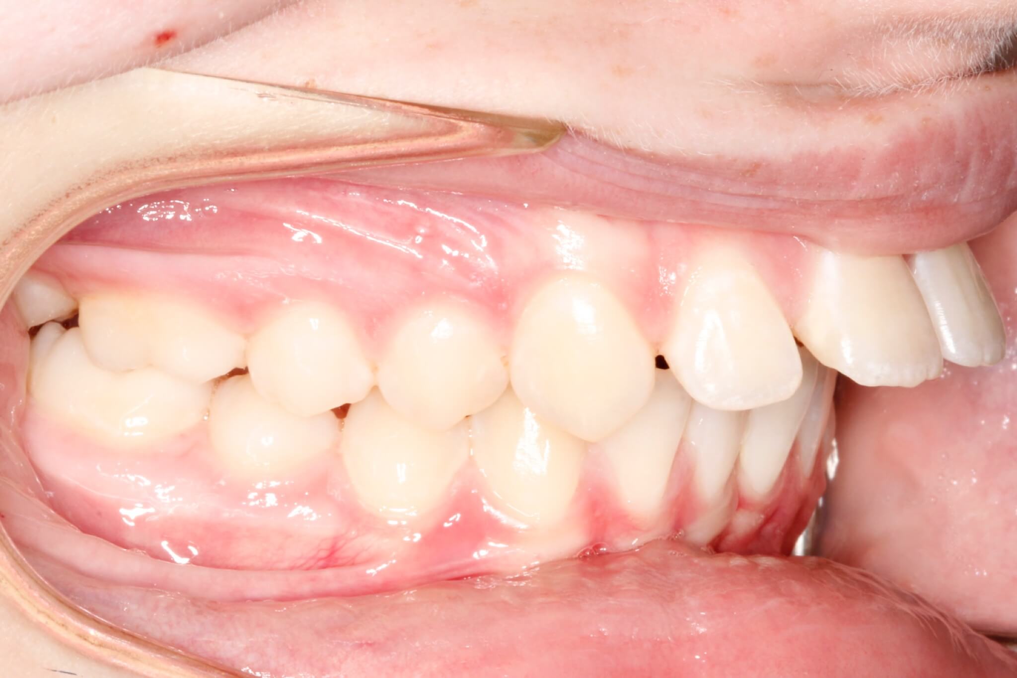 excess-overjet-before excess-overjet-before