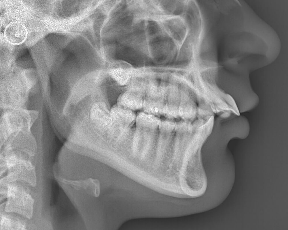 excess-overjet-before2 excess-overjet-before2