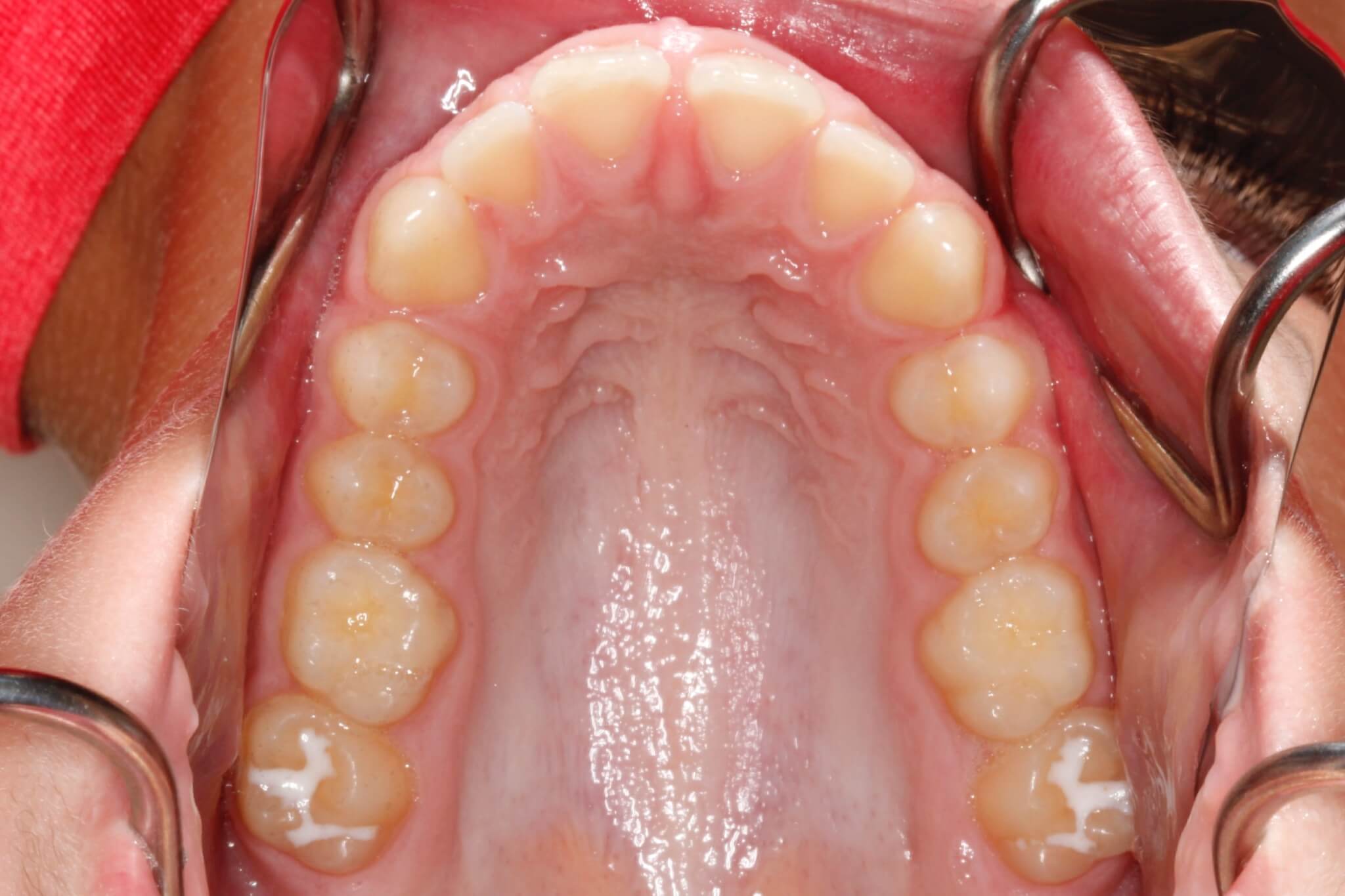 mecc-before mecc-before
