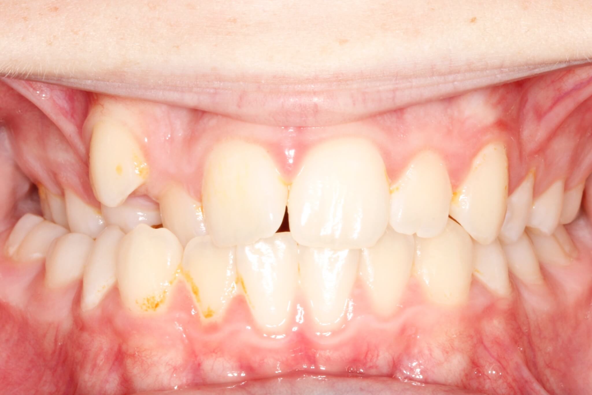 mecc-before2 mecc-before2