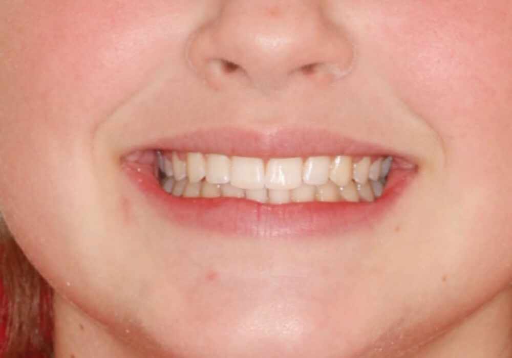 smile-after3