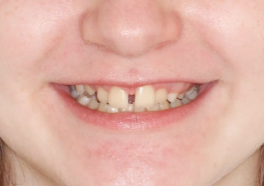 smile-before smile-before