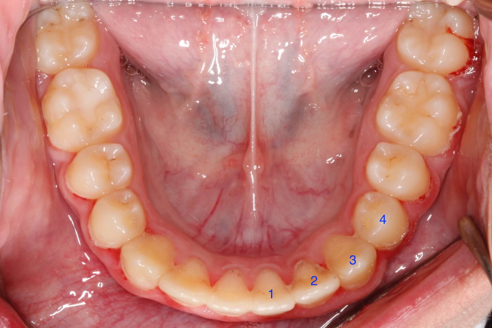 tooth-impactions-after