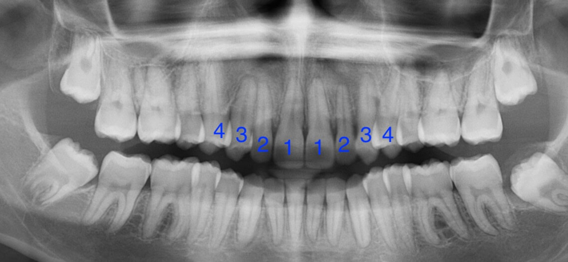 tooth-impactions-after2