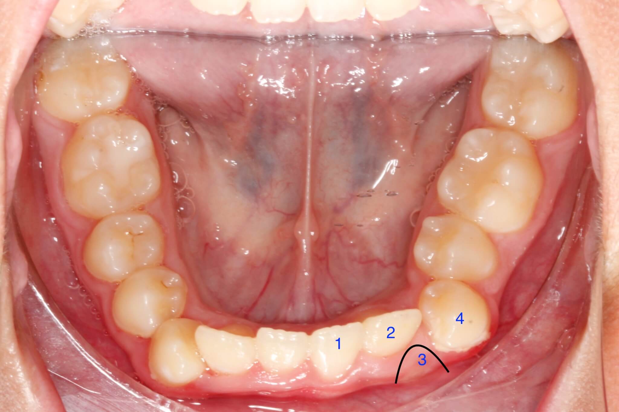 tooth-impactions-before tooth-impactions-before