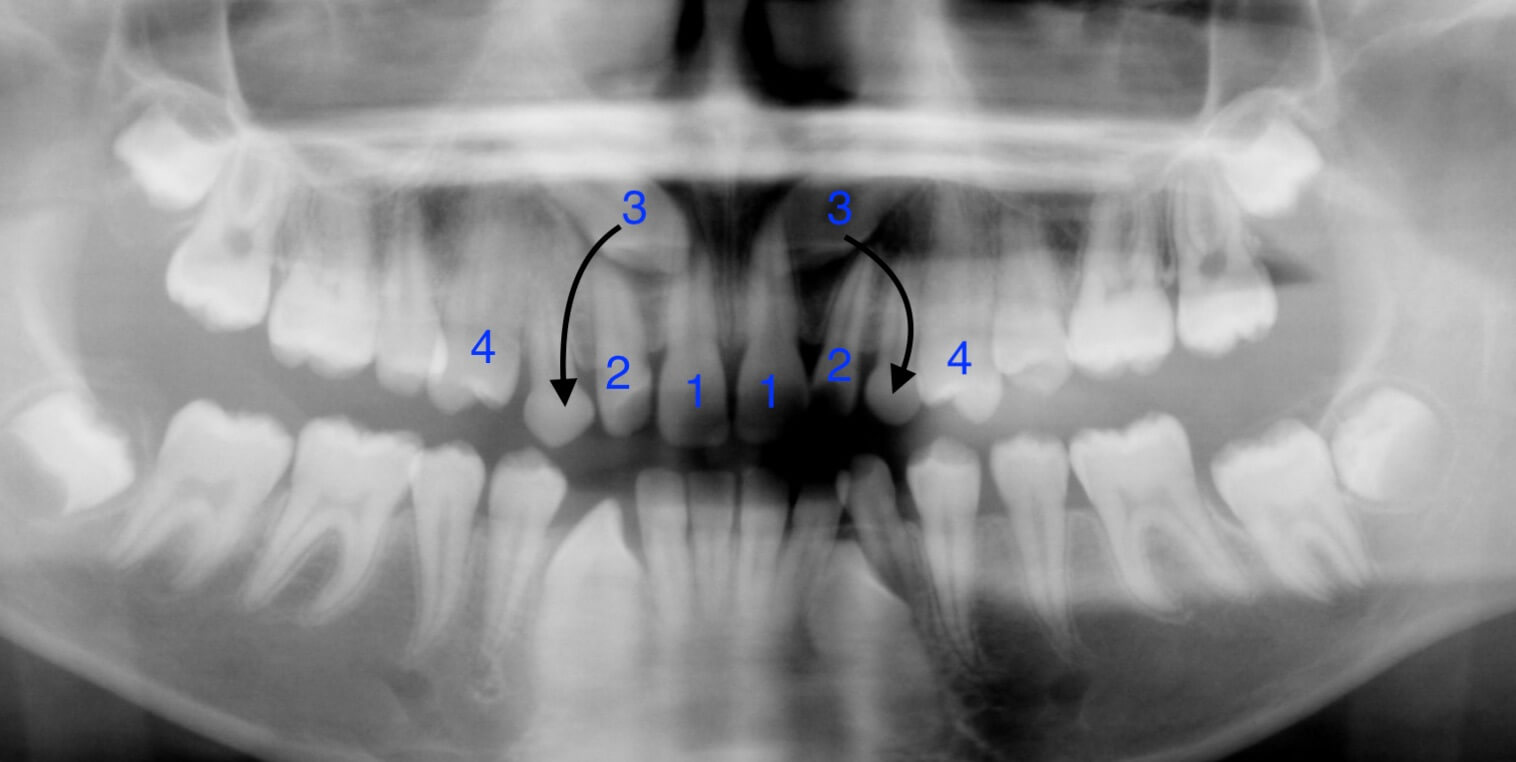 tooth-impactions-before2 tooth-impactions-before2