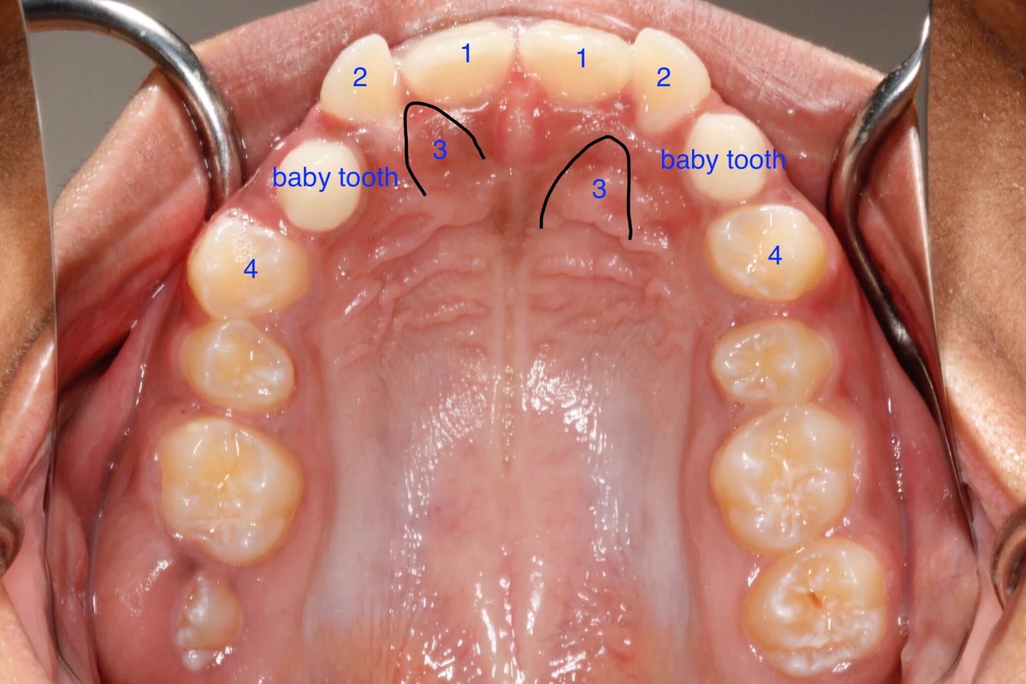 tooth-impactions-before3 tooth-impactions-before3