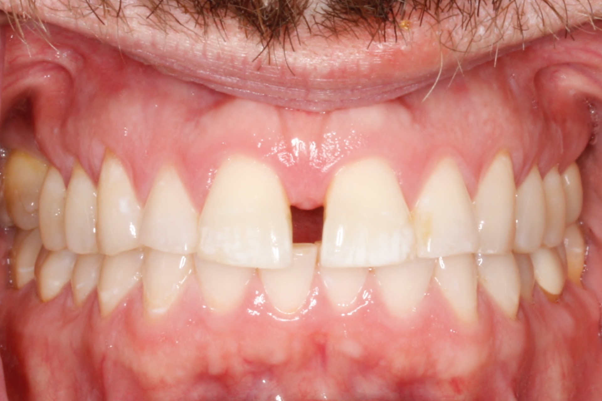 Invisalign6.jpg Invisalign6.jpg