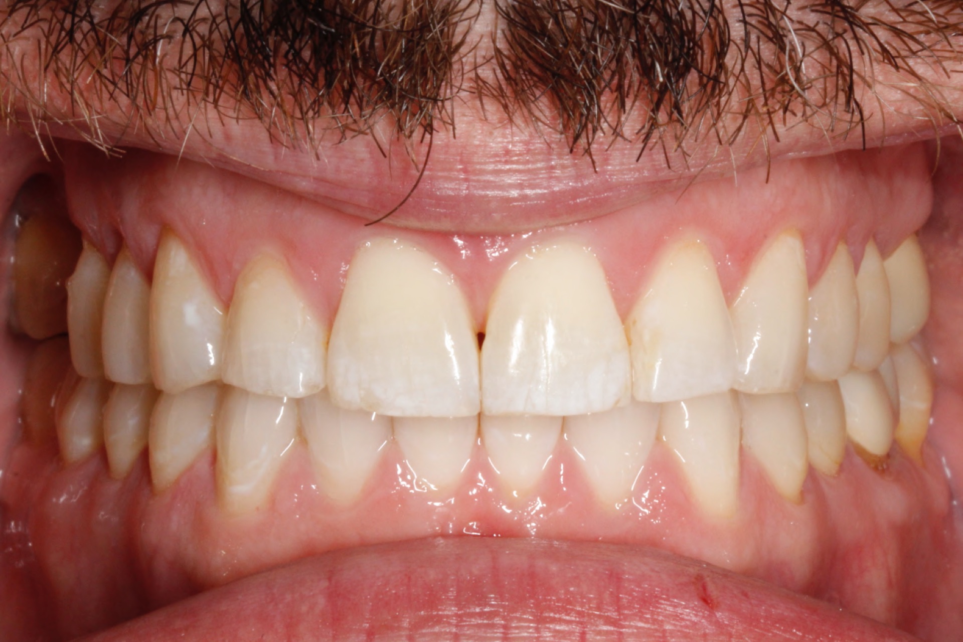 Invisalign6-after.jpg