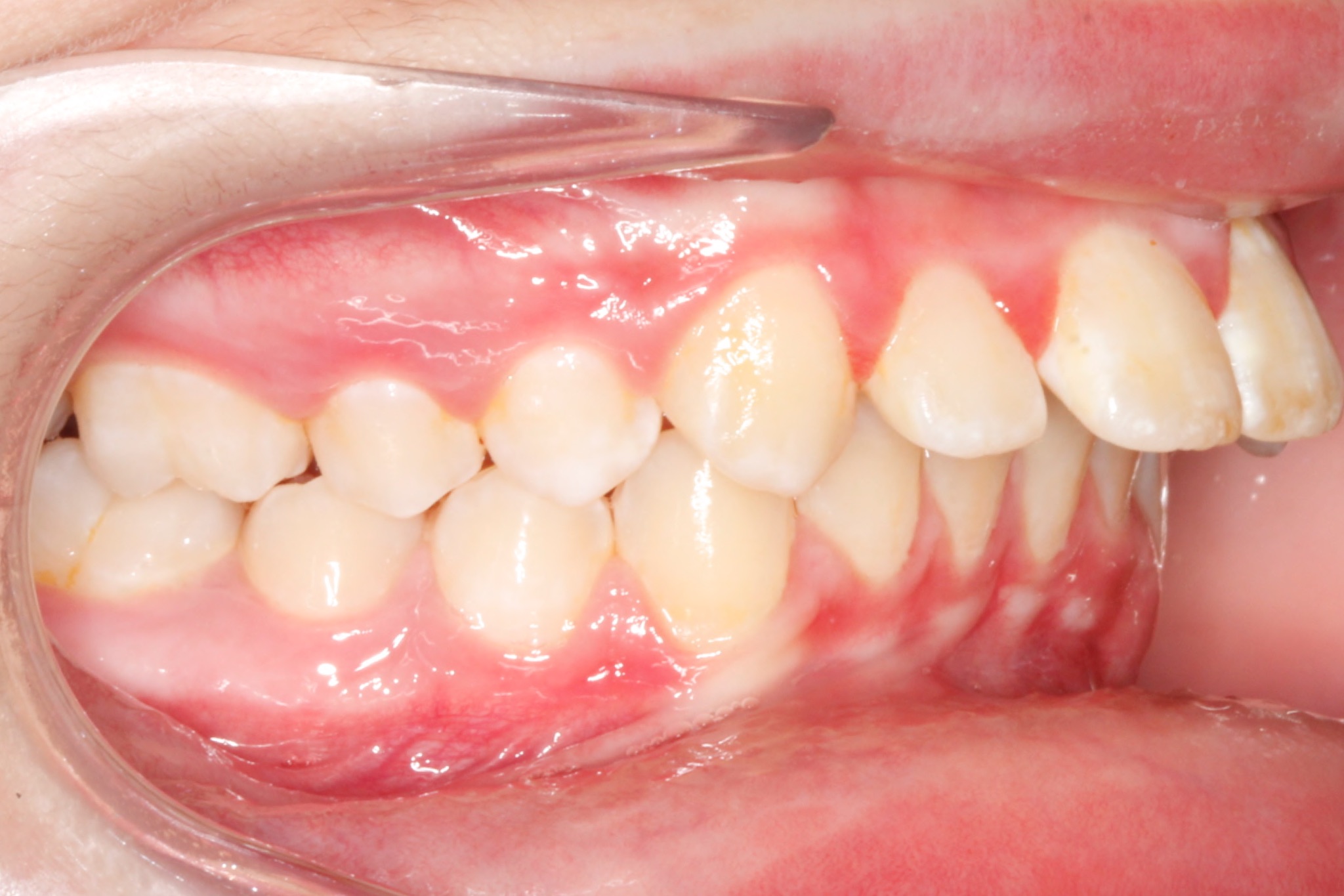 Invisalign7.jpg Invisalign7.jpg