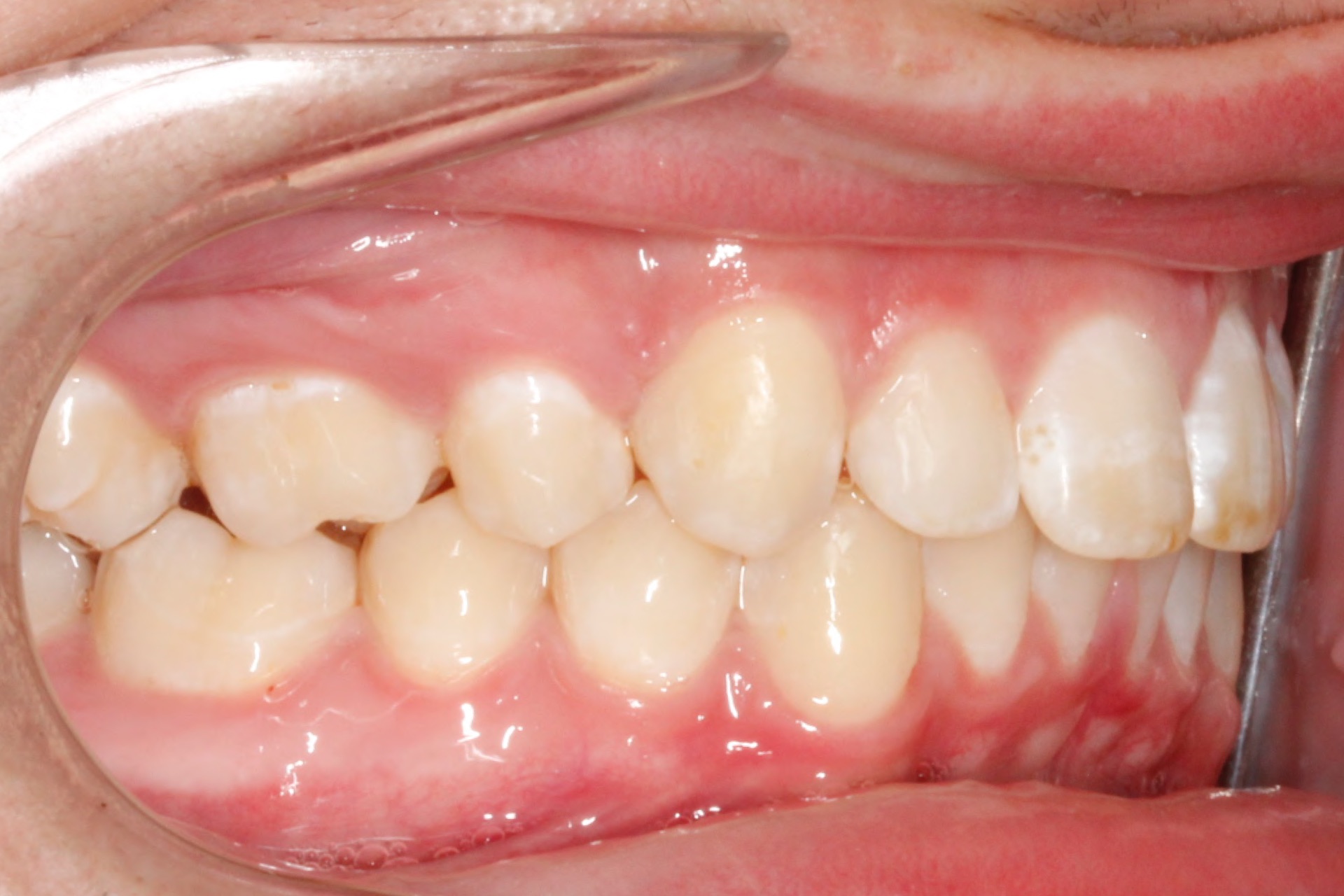 Invisalign7-after.jpg