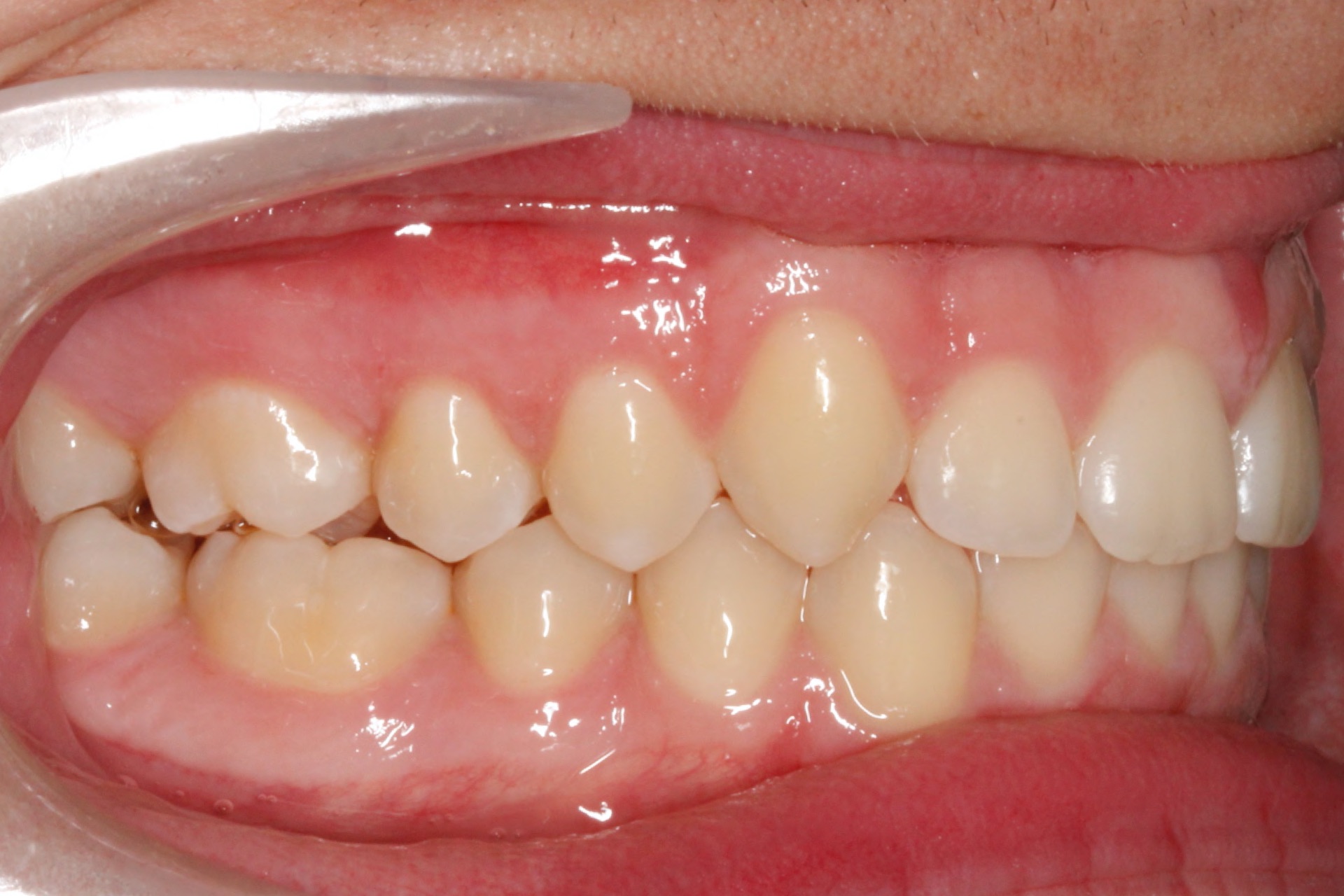 Invisalign9-after