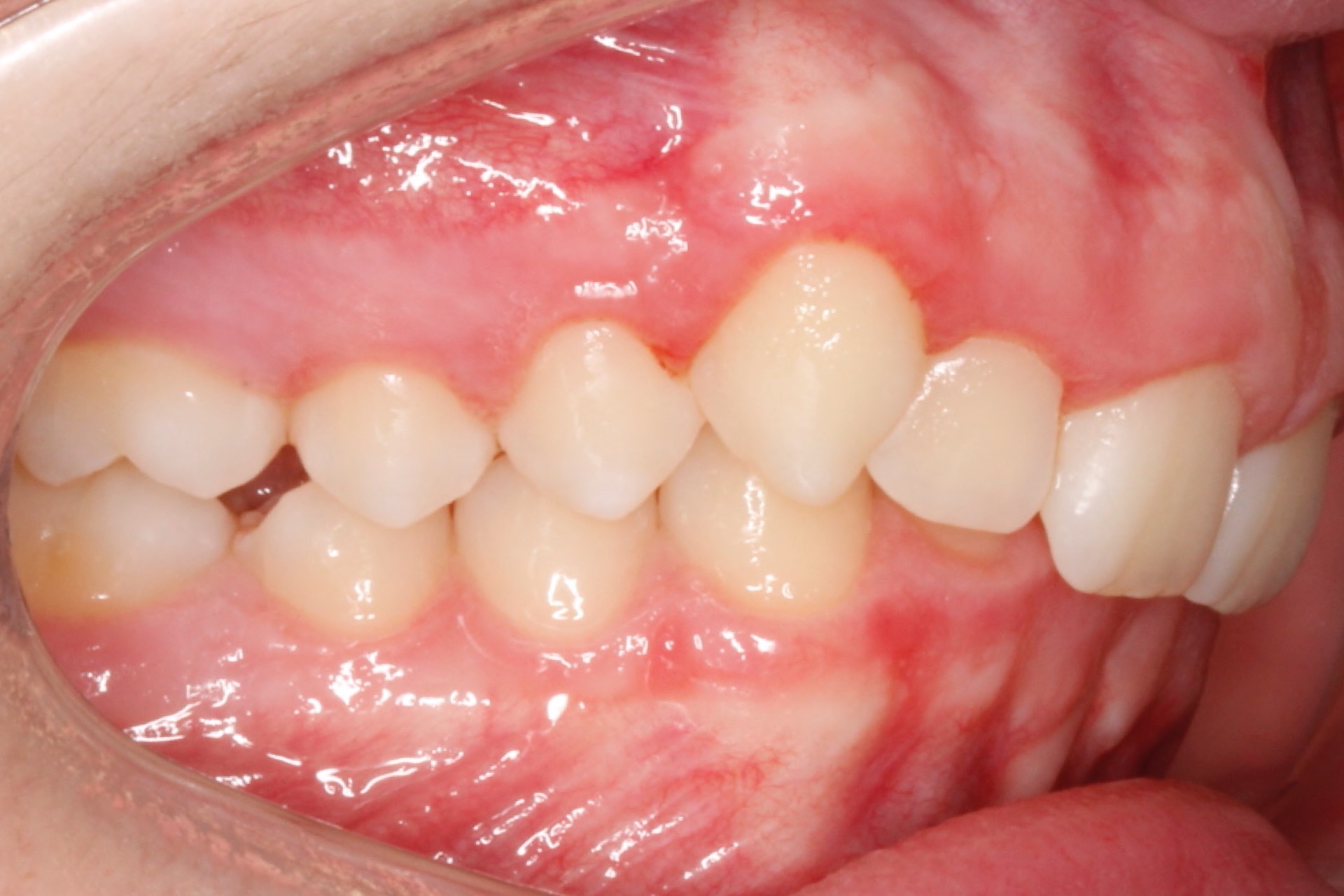 Invisalign9 Invisalign9