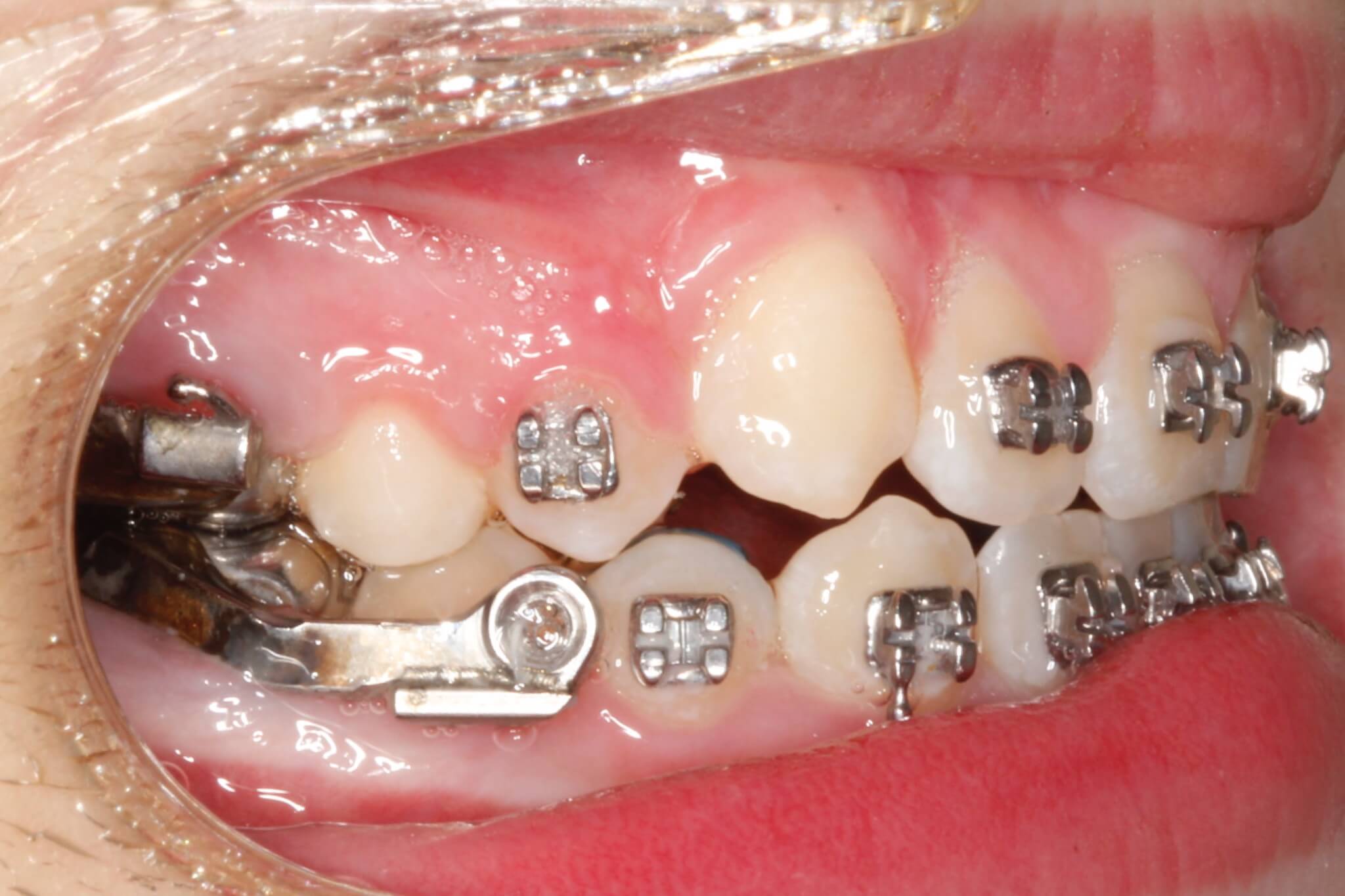 bitecorrection4-after