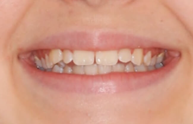 deepbites11 deepbites11