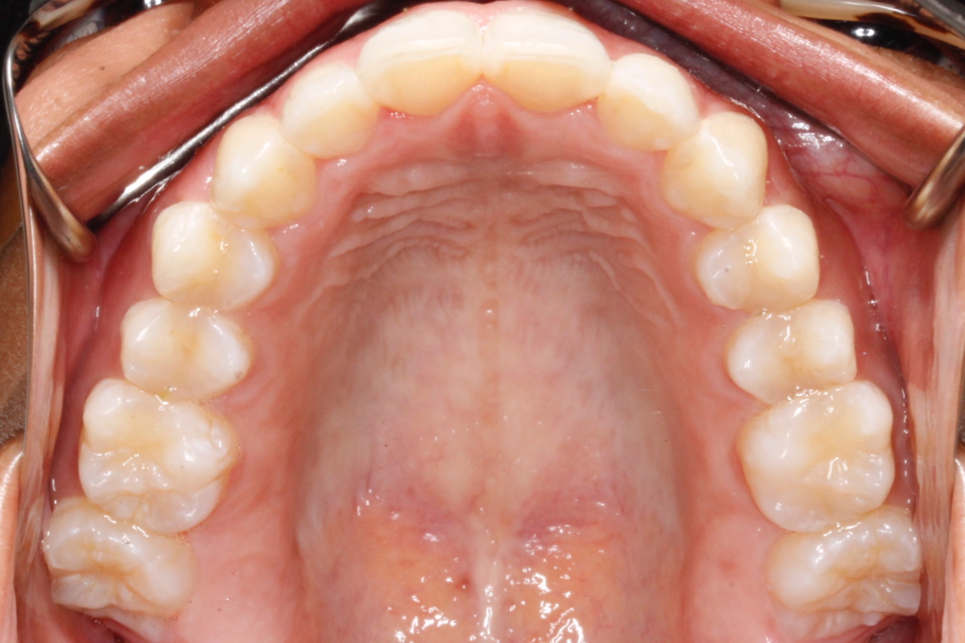 dental-crowding4-after