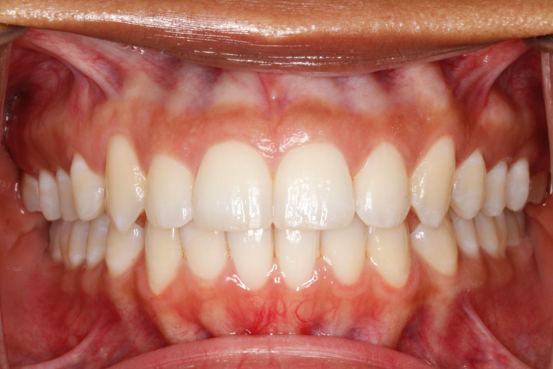 dental-crowding5-after