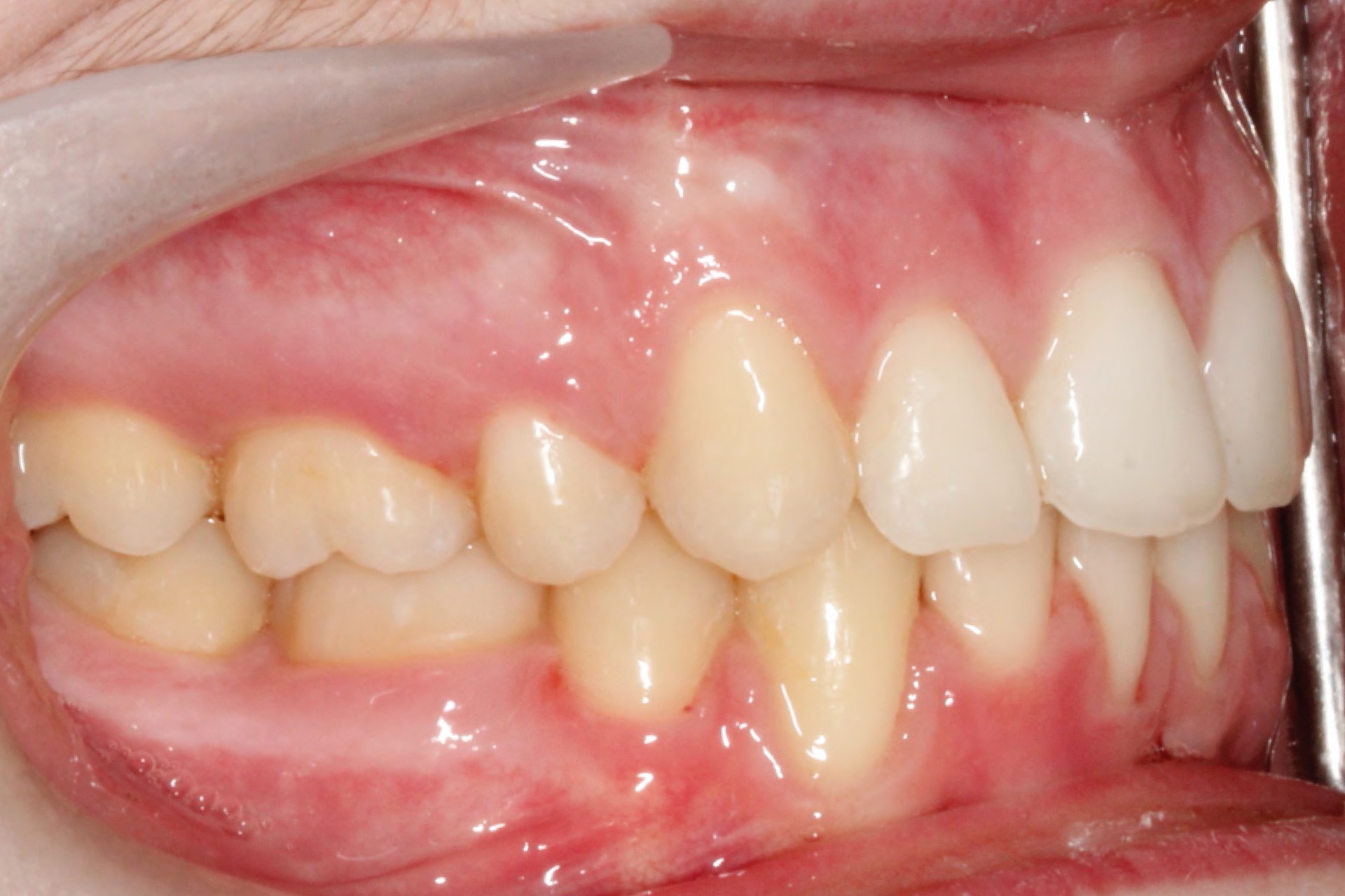 excess-overjet3-after