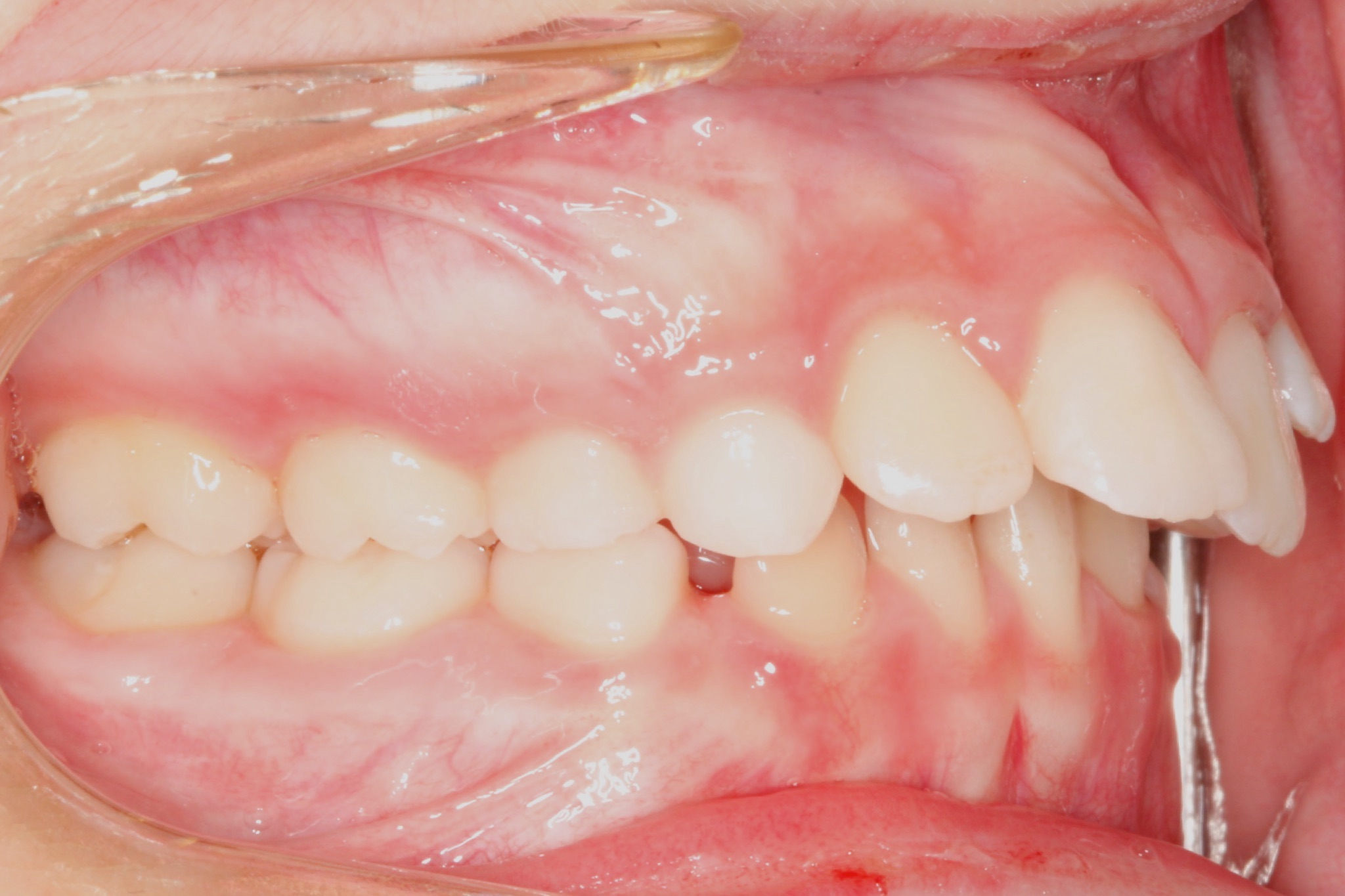 excess-overjet3 excess-overjet3