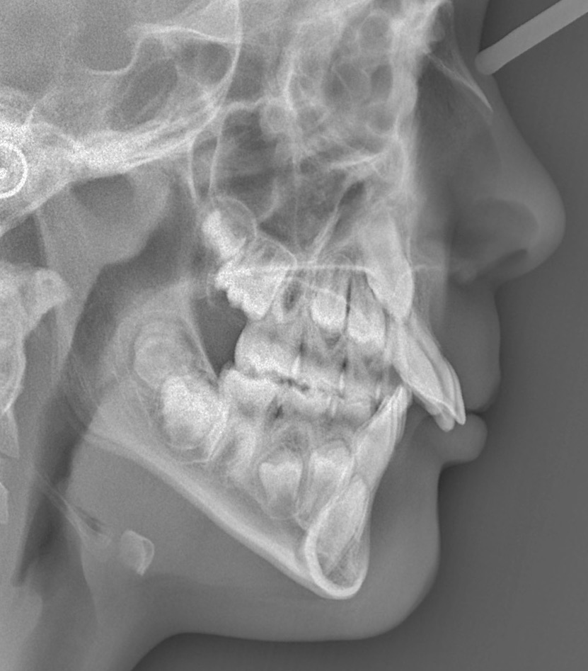 excess-overjet4-after