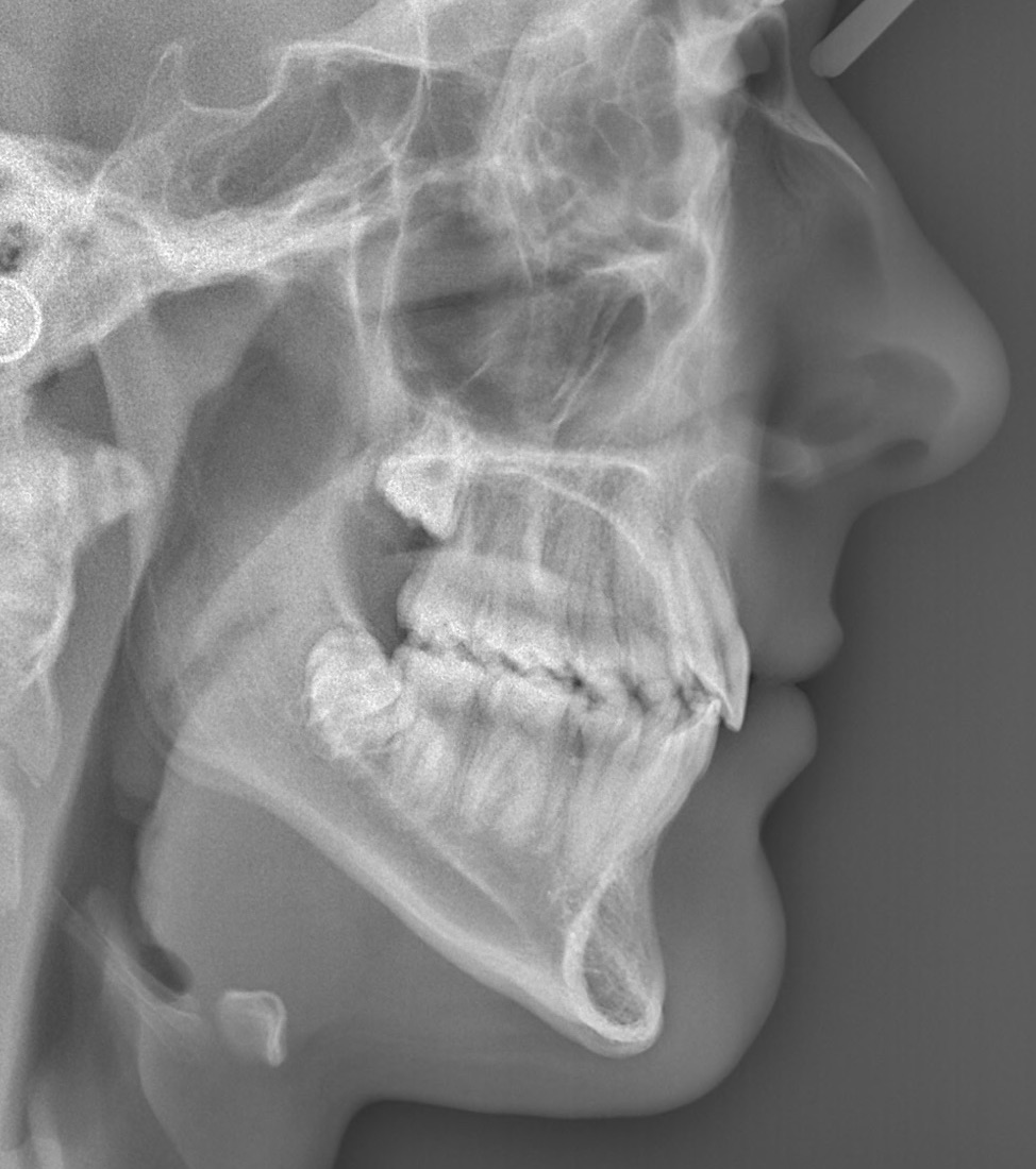 excess-overjet4 excess-overjet4