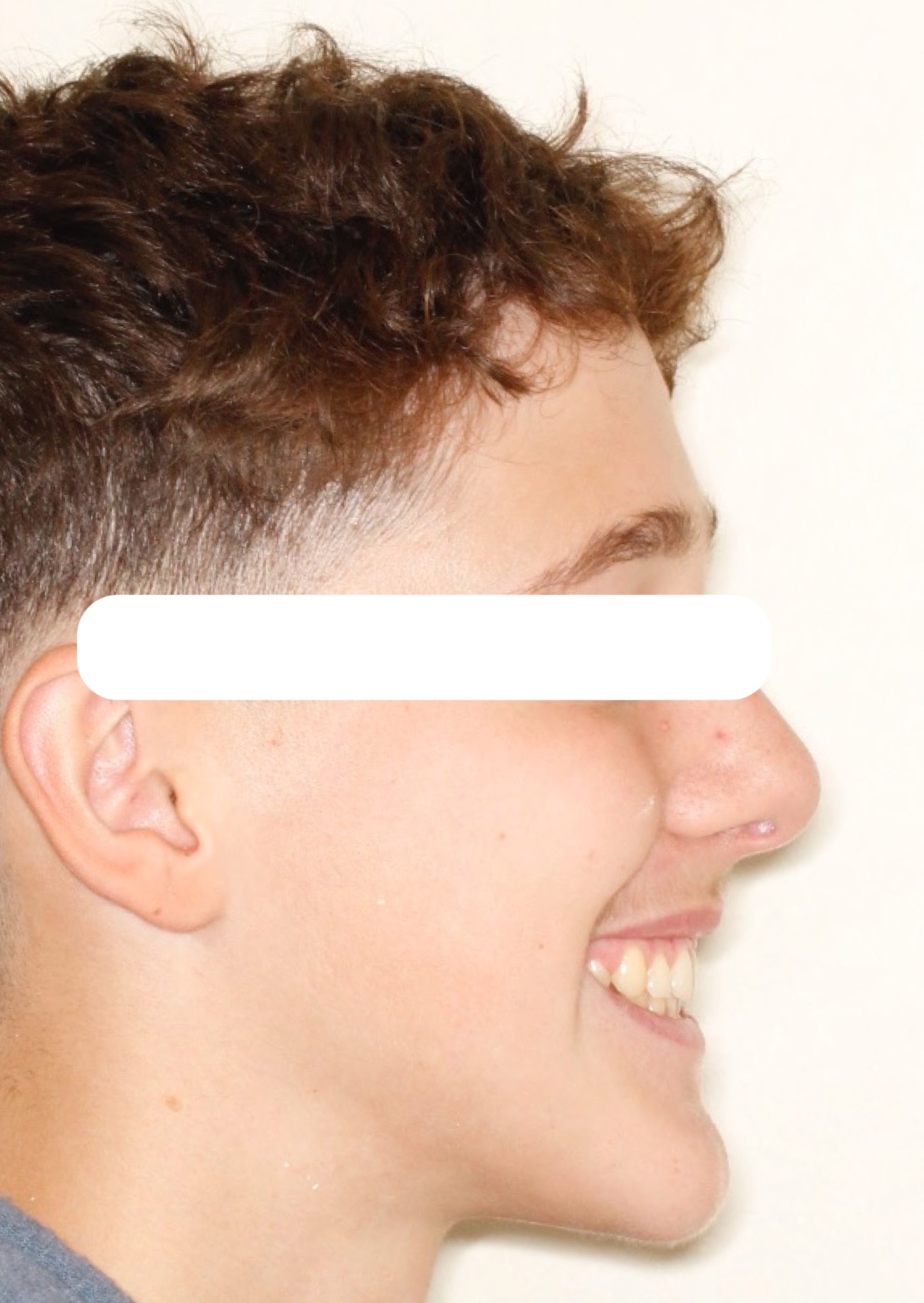 excess-overjet5-after