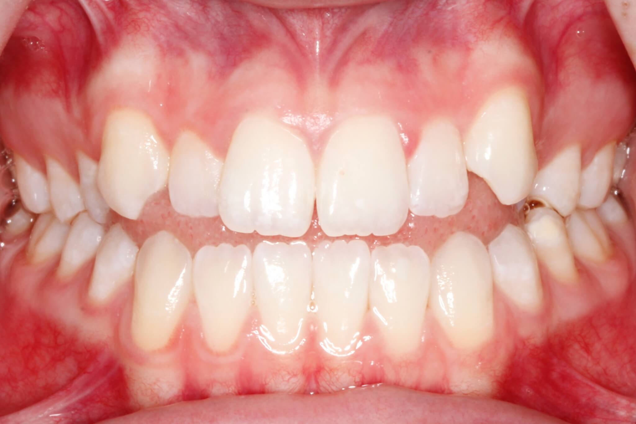 invasalign4.jpg invasalign4.jpg