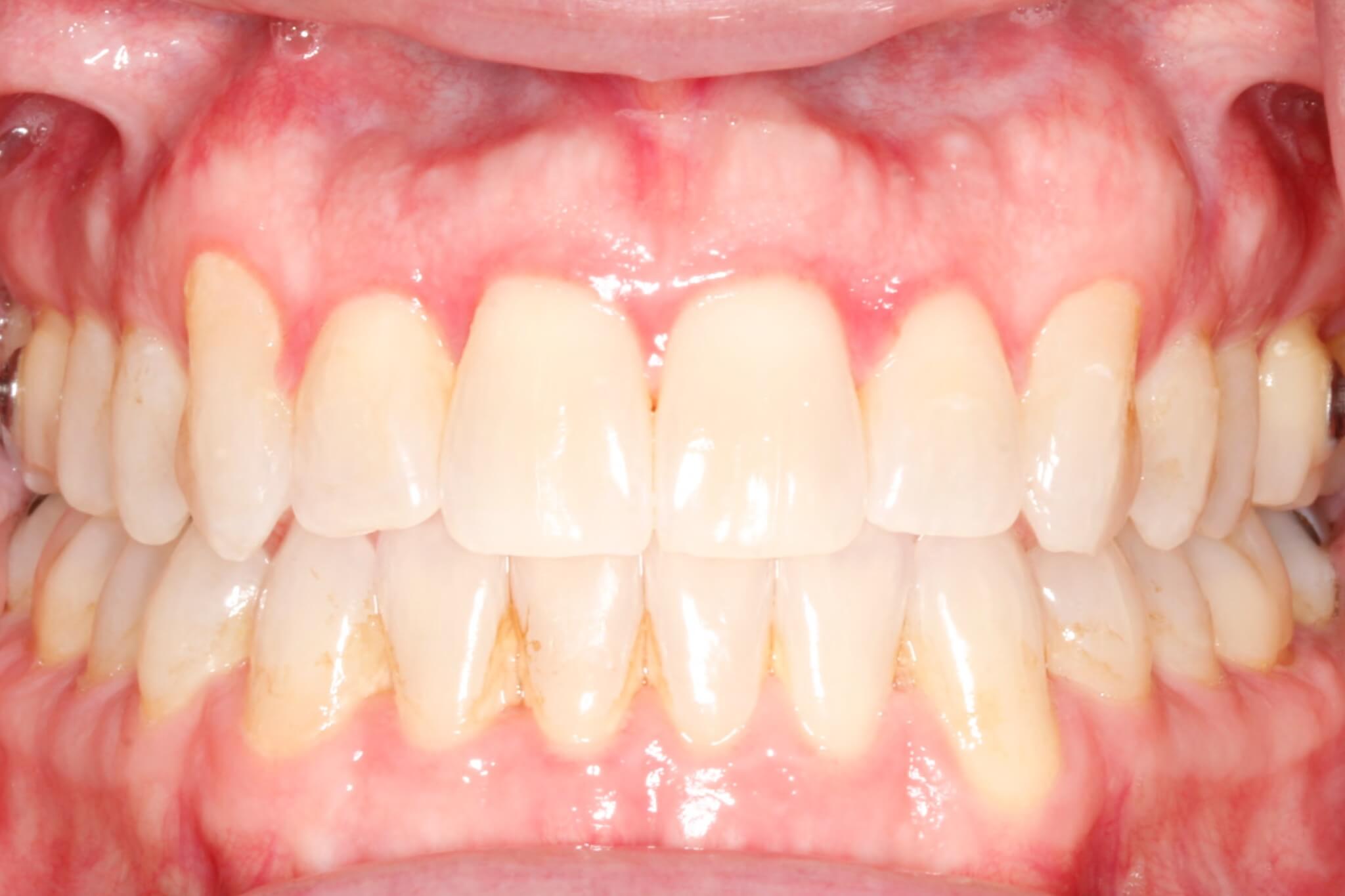 invisalign invisalign