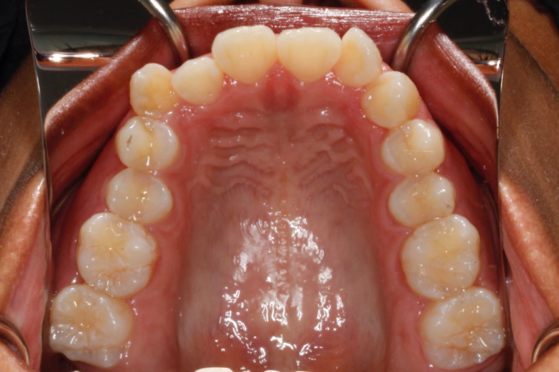 invisalign10 invisalign10