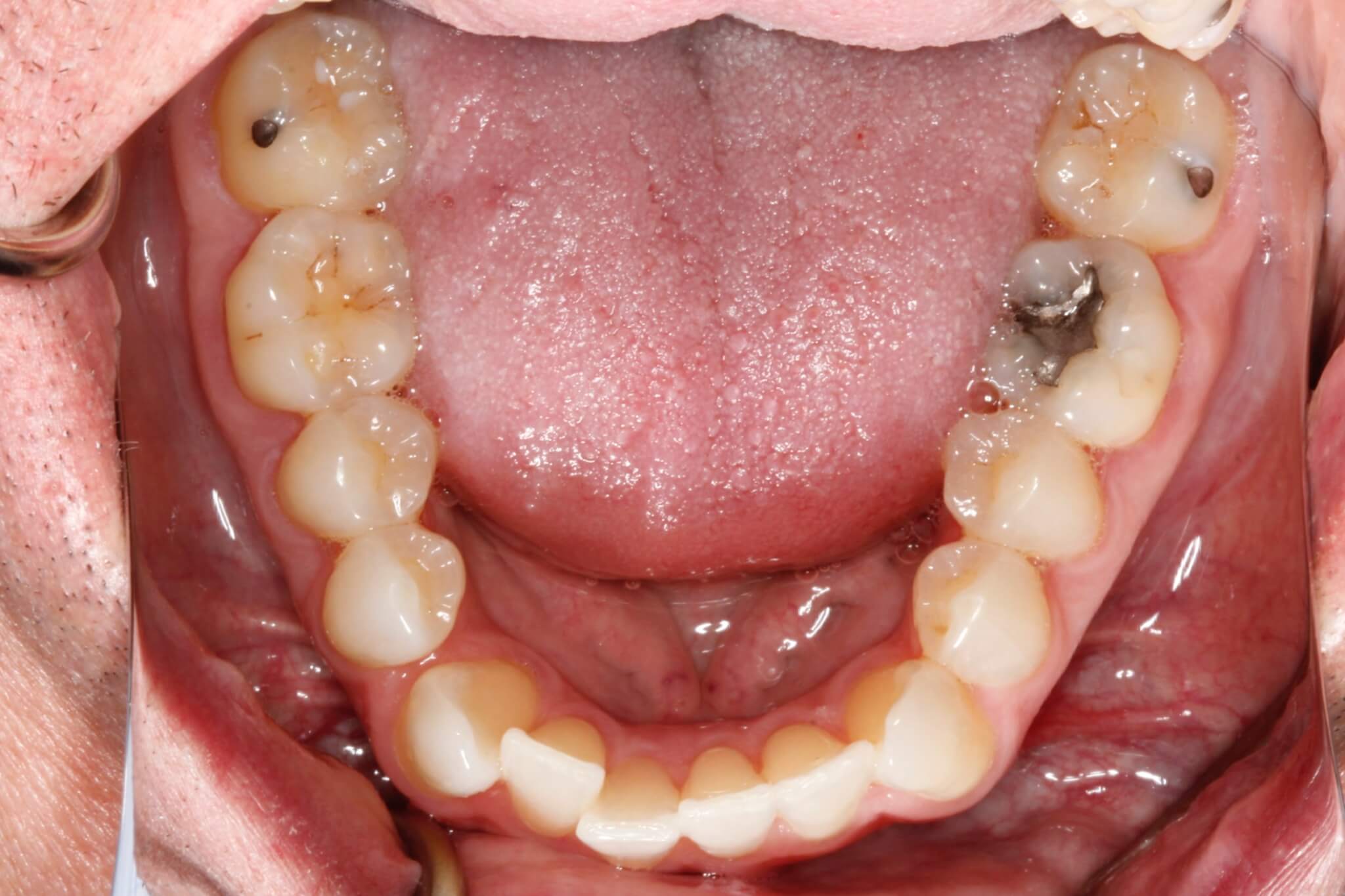 invisalign3.jpg invisalign3.jpg