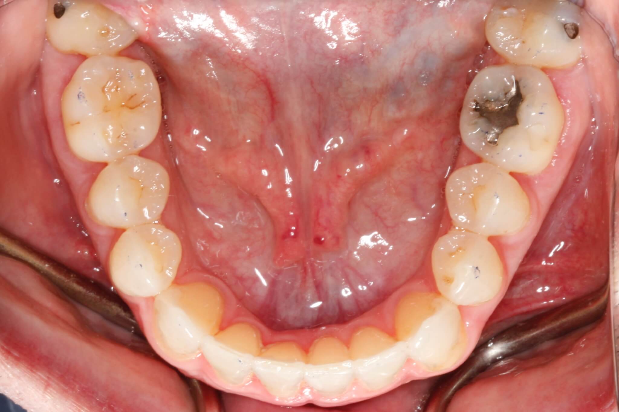 invisalign3-after