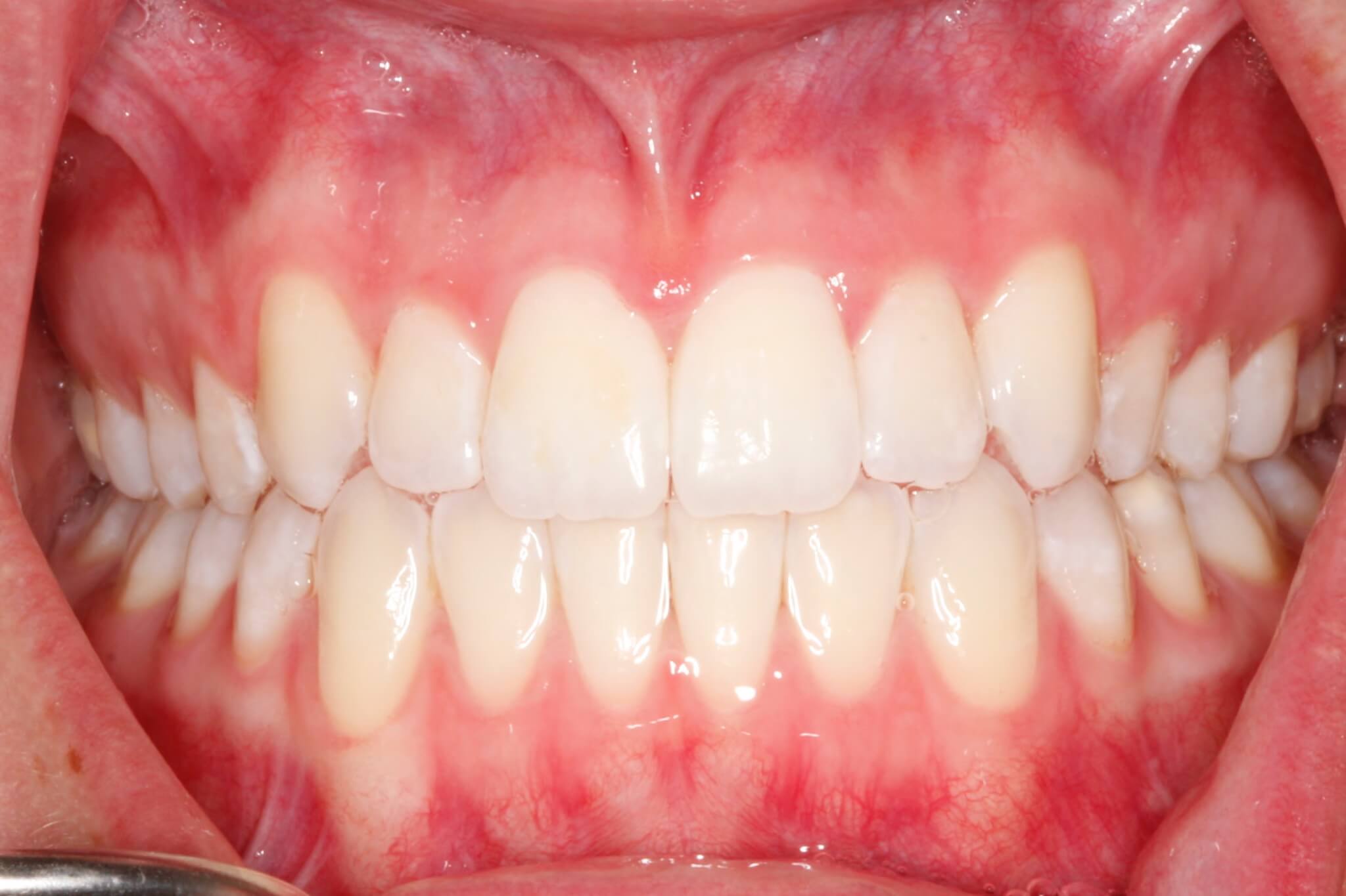 invisalign4-after