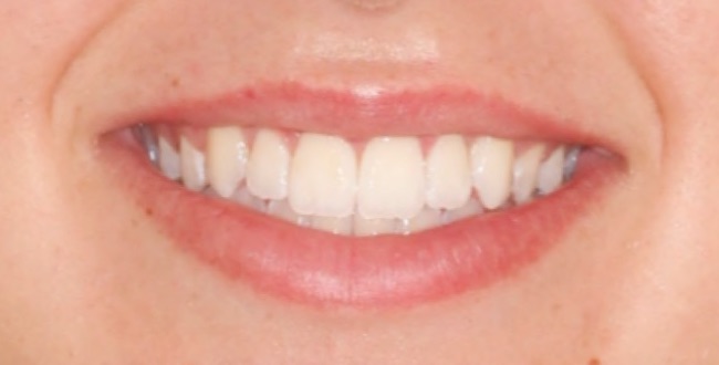 invisalign5-after.jpg