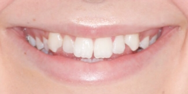invisalign5 invisalign5