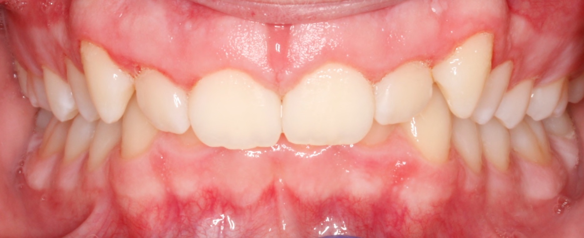 invsisalign11 invsisalign11