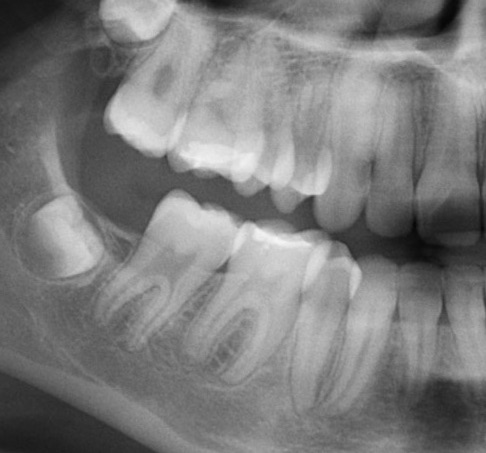 space-closure-bc1-after